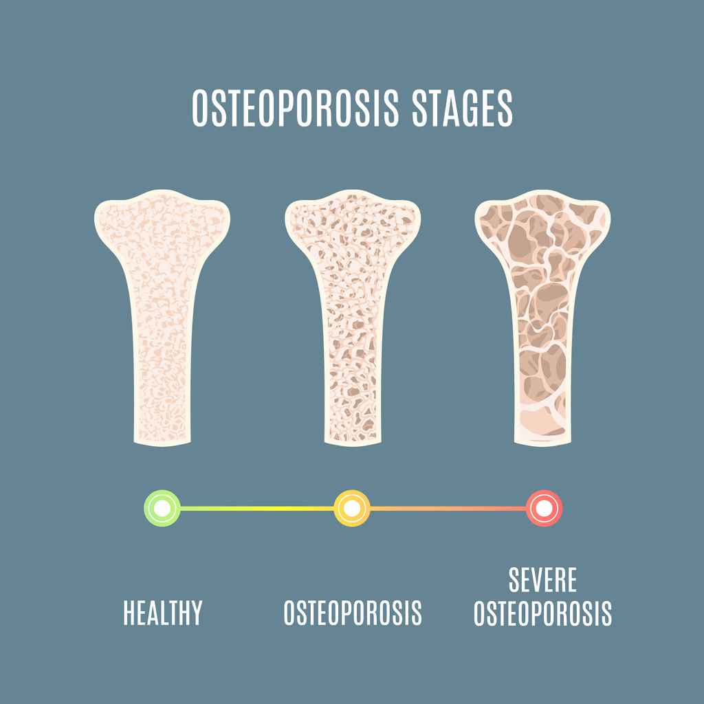 “Cegah Osteoporosis Sejak Dini: Nutrisi & Aktivitas Fisik yang Tepat”