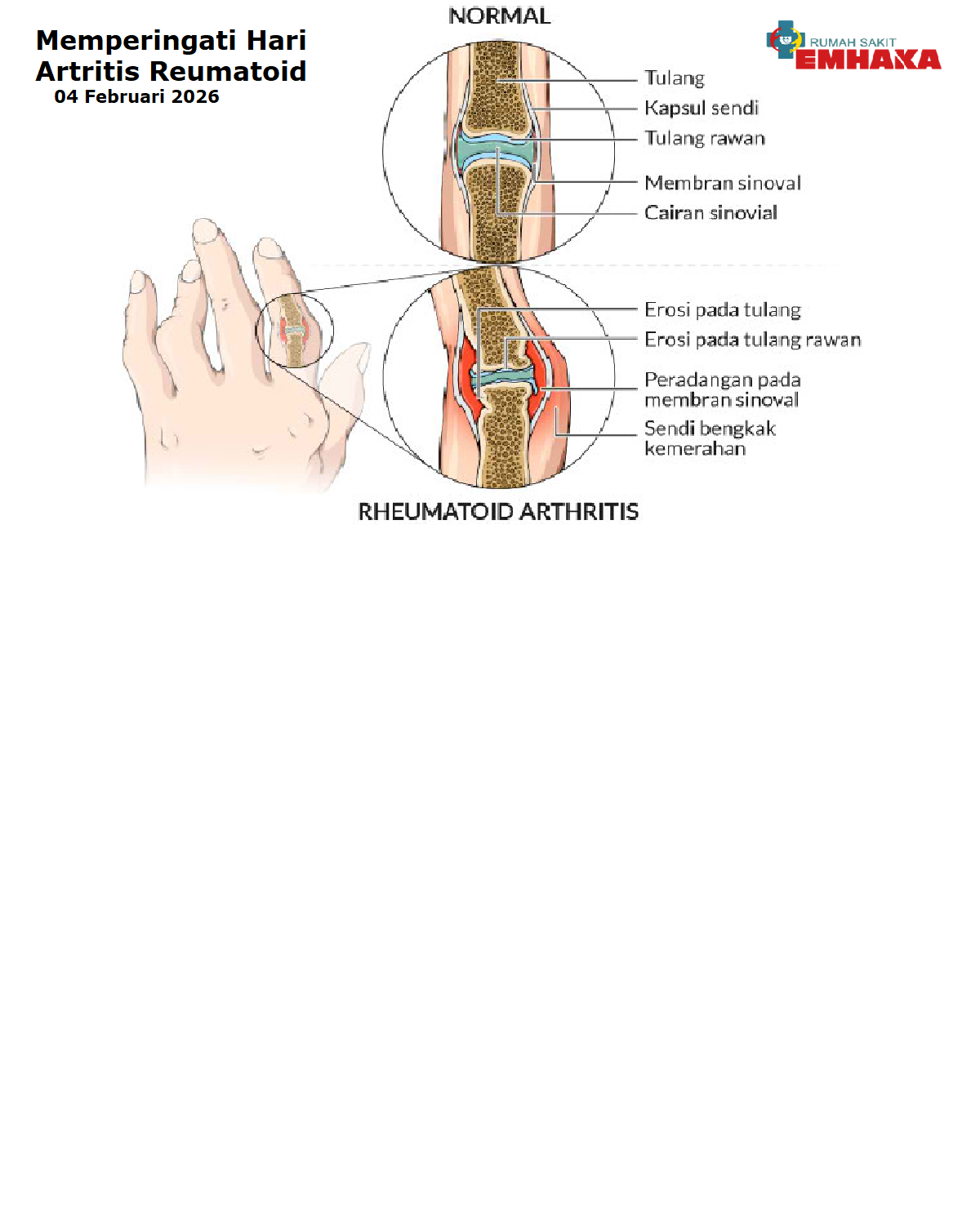 Memperingati Hari Arthritis Rheumatoid